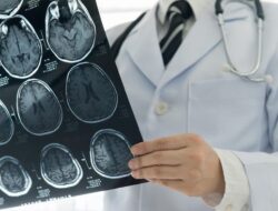 Pasien Stroke Kian Muda, Dokter Sebut Ada yang Usia 6 Tahun