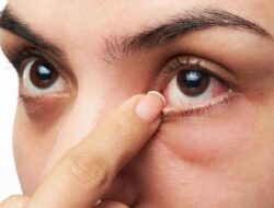 Ini Tanda Kolesterol Tinggi pada Mata yang Wajib Diperhatikan